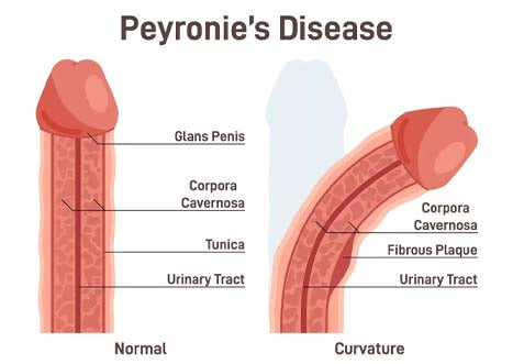 All You Need To Know About Peyronie's