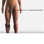 GrowMax Pro male extender kit with silicone ring and traction cord